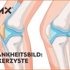 Vergleich von Kniegelenken: Links ein gesundes Knie, rechts eine Bakerzyste, die sich hinter dem Knie bildet.