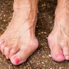 Füße mit Hallux Valgus, einer häufigen Ursache für Fußschmerzen. Die Zehen sind deformiert, der Ballen am großen Zeh ist deutlich sichtbar.