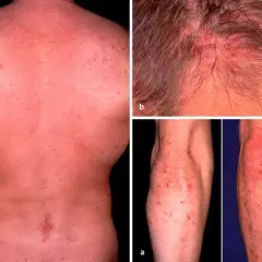 Morbus Duhring Diagnostik: Wichtige Tests und Verfahren zur sicheren Diagnose
