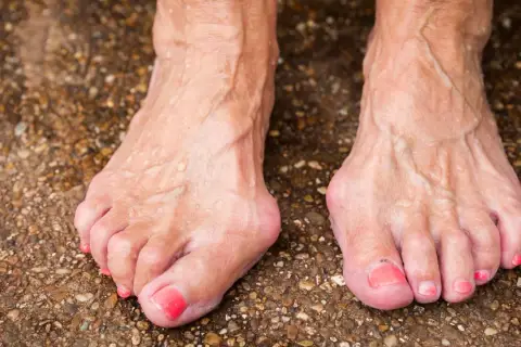 Füße mit Hallux Valgus, einer häufigen Ursache für Fußschmerzen. Die Zehen sind deformiert, der Ballen am großen Zeh ist deutlich sichtbar.