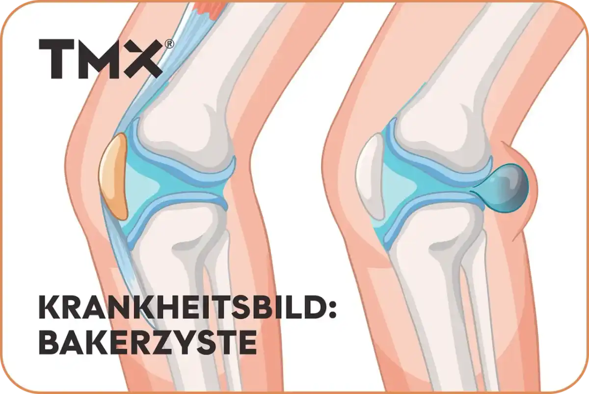 Bakerzyste in der Kniekehle - was wirklich hilft und wann zum Arzt
