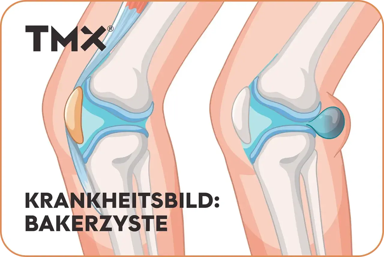 Vergleich von Kniegelenken: Links ein gesundes Knie, rechts eine Bakerzyste, die sich hinter dem Knie bildet.
