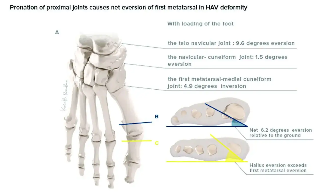 Fußskelett zeigt, wie Pronation der Gelenke zur Hallux-Ursache (Ballenzeh) beiträgt.