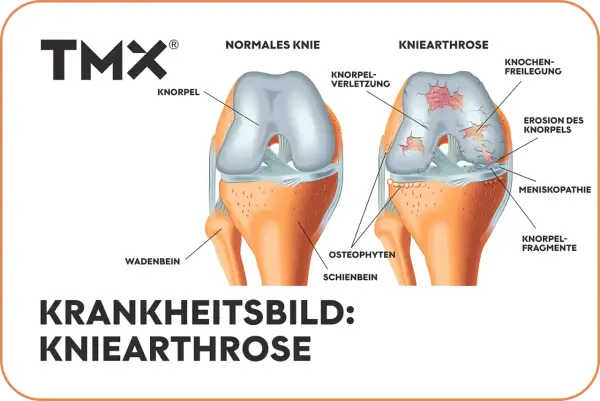 Vergleich von gesundem Knie und Kniearthrose. Die Darstellung zeigt Knorpelverschleiß, Erosionen und Knochenreizungen – eine mögliche "wunderwaffe gegen arthrose knie" könnte hier Abhilfe schaffen.