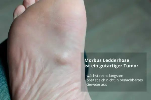Fußsohle mit Knoten, typisch für Morbus Ledderhose bei Frauen. Der gutartige Tumor wächst langsam.
