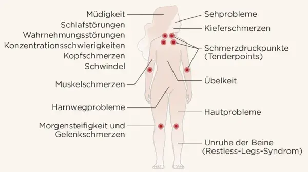 Übersicht der Symptome bei Fibromyalgie: Müdigkeit, Schmerzen, Schlafstörungen, Konzentrationsprobleme und Schmerzdruckpunkte (Tenderpoints) sind typisch.