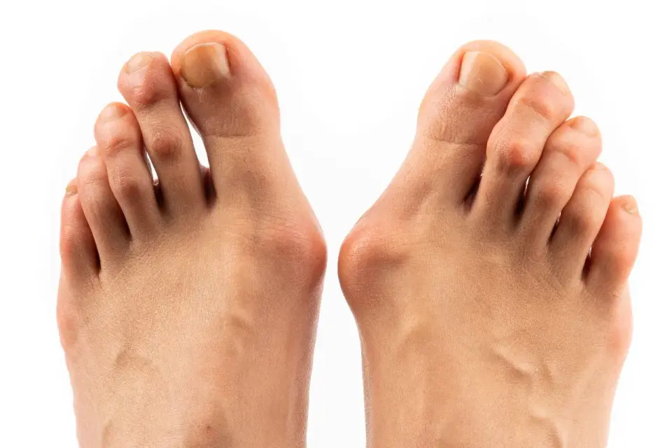 Hallux-valgus-Operation - wann sie wirklich sinnvoll ist