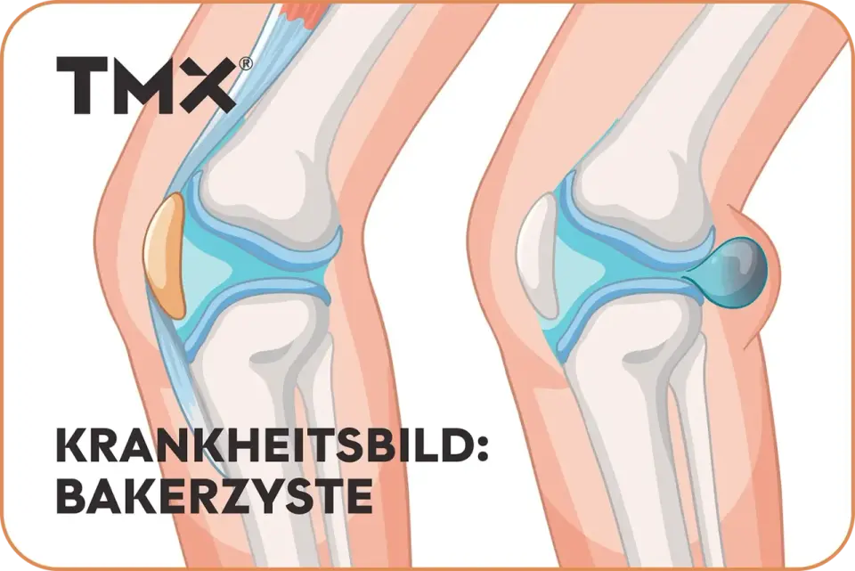 Bakerzyste in der Kniekehle - was wirklich hilft und wann zum Arzt