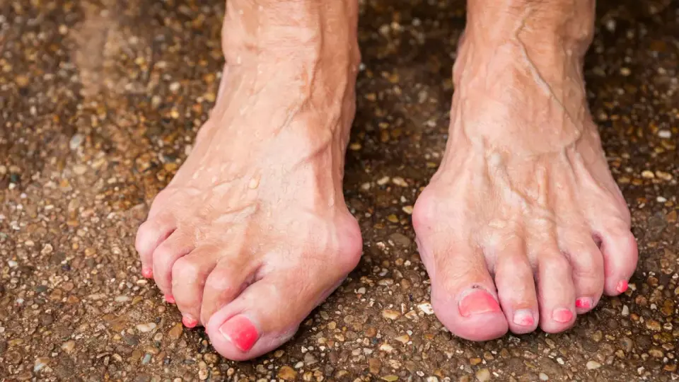 Hallux valgus Ursachen - was den Ballenzeh wirklich antreibt